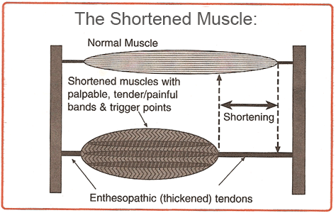 shortened muscle